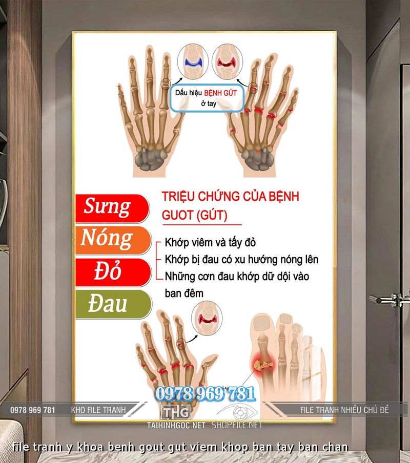 file tranh y khoa benh gout gut viem khop ban tay ban chan