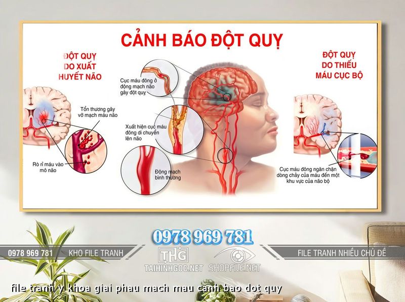 file tranh y khoa giai phau mach mau canh bao dot quy